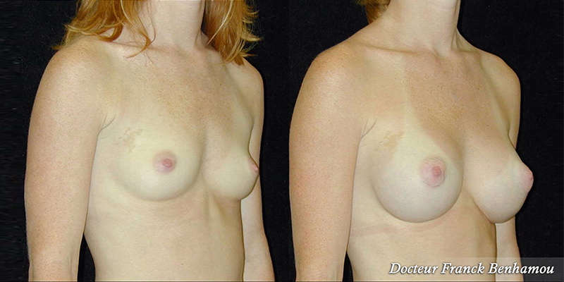 Photo avant - après augmentation mammaire