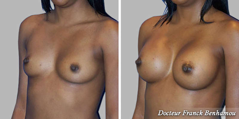 Photo avant - après chirurgie mammaire