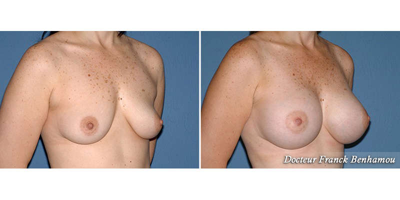 Photo avant - après chirurgie réduction poitrine