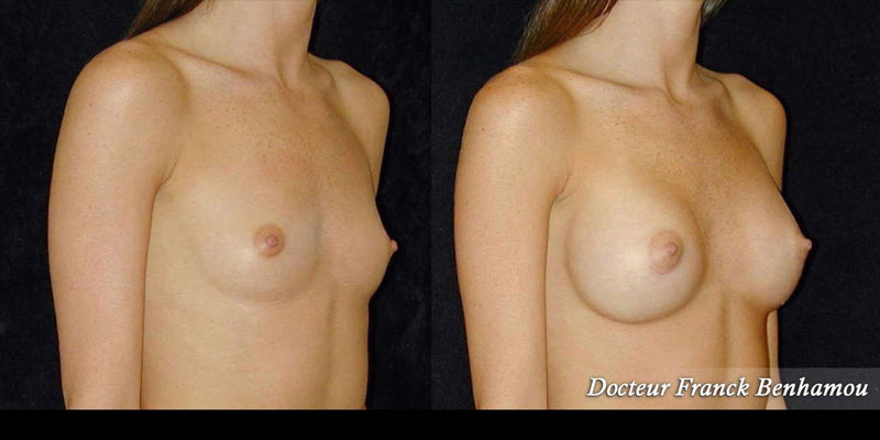 Photo avant - après opération des seins