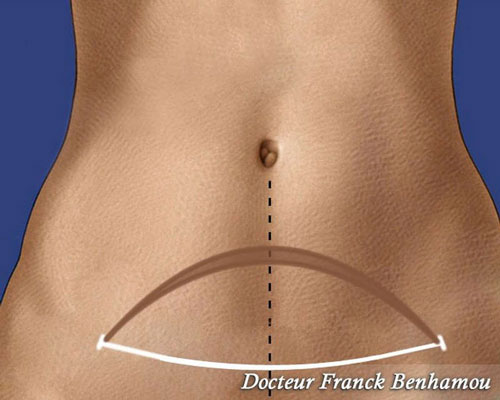 chirurgie esthétique du ventre