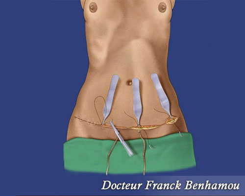chirurgie plastique du ventre