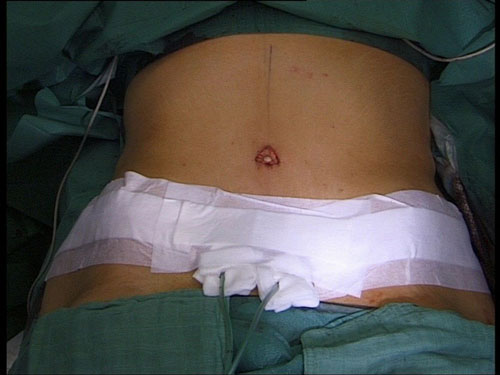 Pansements post opératoires abdominoplastie