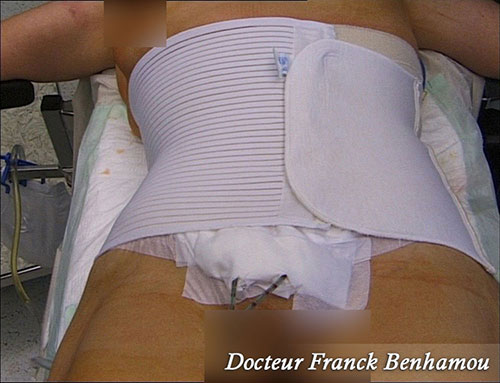 Pansements post opératoires abdominoplastie avec gaine