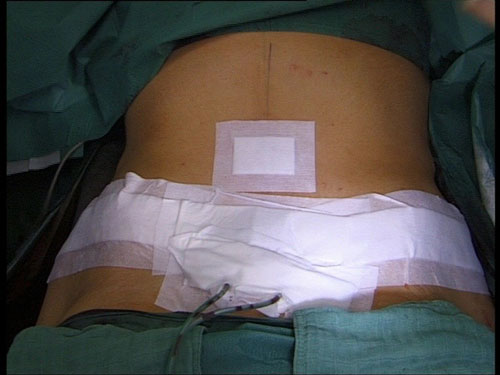 Pansements post opératoires chirurgie abdominaux