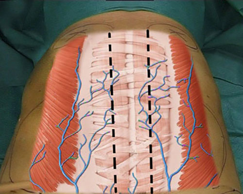 Schéma muscles abdominoplastie