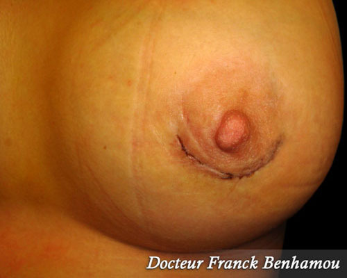 Cicatrices aréolaires après augmentation mammaire jour 1