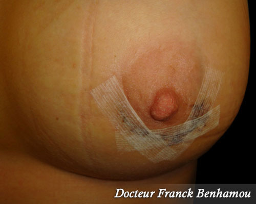 Pansements de cicatrices aréolaires après augmentation mammaire jour 1