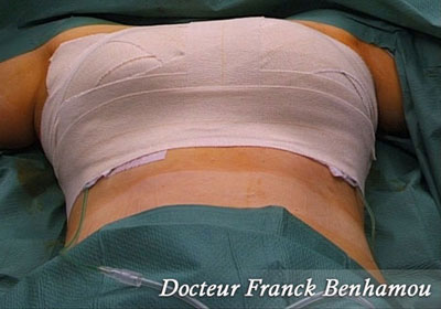 Pansements post-opératoires après pose de prothèses mammaires