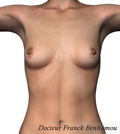 Schéma d'incisions aréolaire inférieure avant chirurgie mammaire