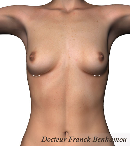 Schéma d'incisions sous-mammaire avant opération chirurgicale