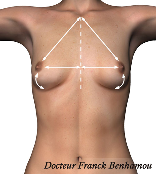Schéma des mesures de poitrine avant opération chirurgicale