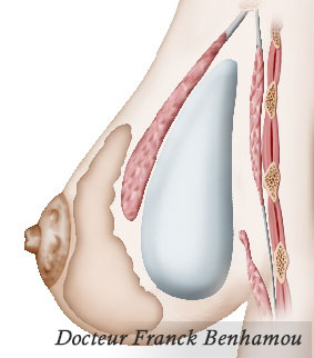 Schéma de prothèses biplan pour hypoplasie des seins