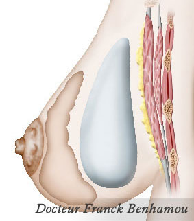 Schéma de prothèses pre-musculaire pour hypoplasie des seins