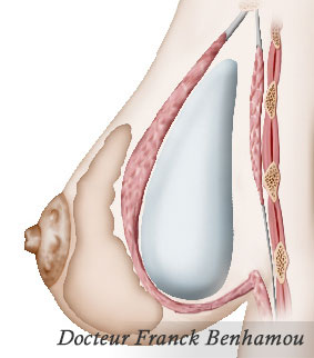 Schéma de prothèses retro-musculaire pour hypoplasie des seins