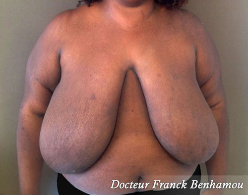 Réduction mammaire à Paris - Diminuer la poitrine.