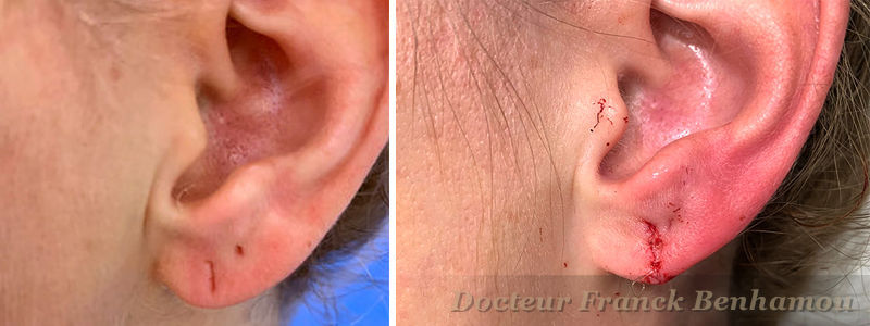 chirurgie de lobule d'oreille