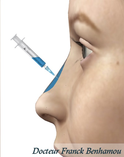 Remodalage du nez par acide hyaluronique pour la rhinoplastie médicale
